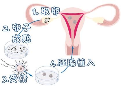 关于助孕儿子包成功